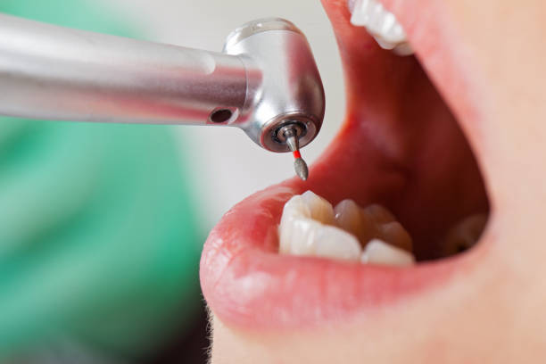 Best Emergency Dental Extractions in Minooka, IL